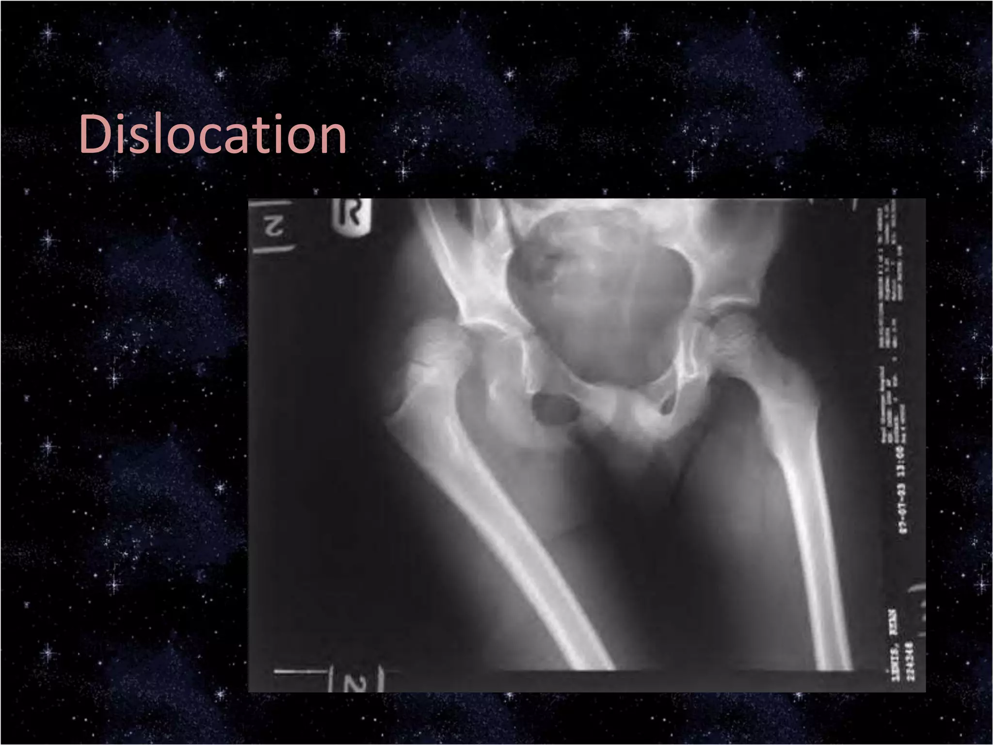 Dislocation