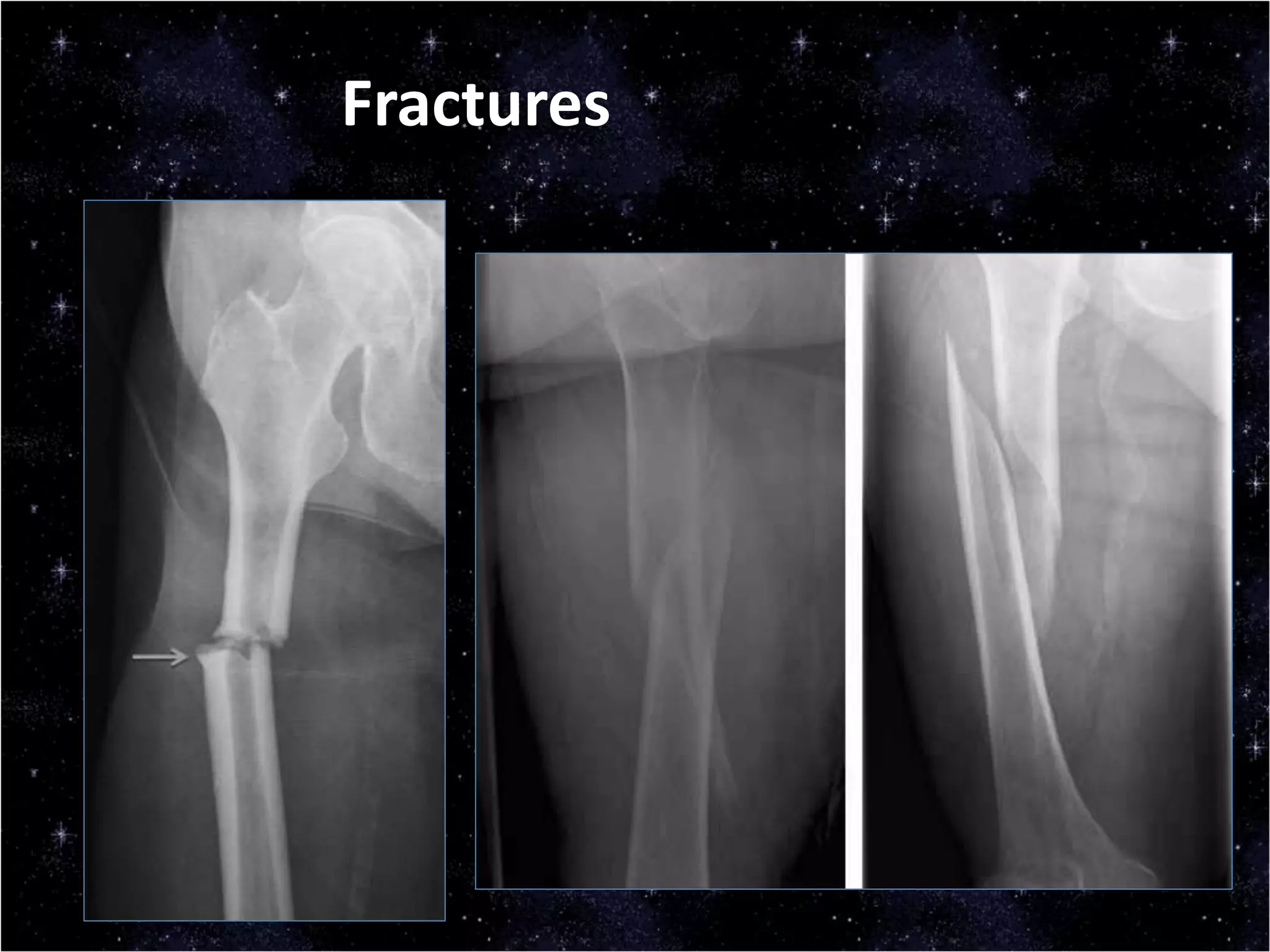 Fractures