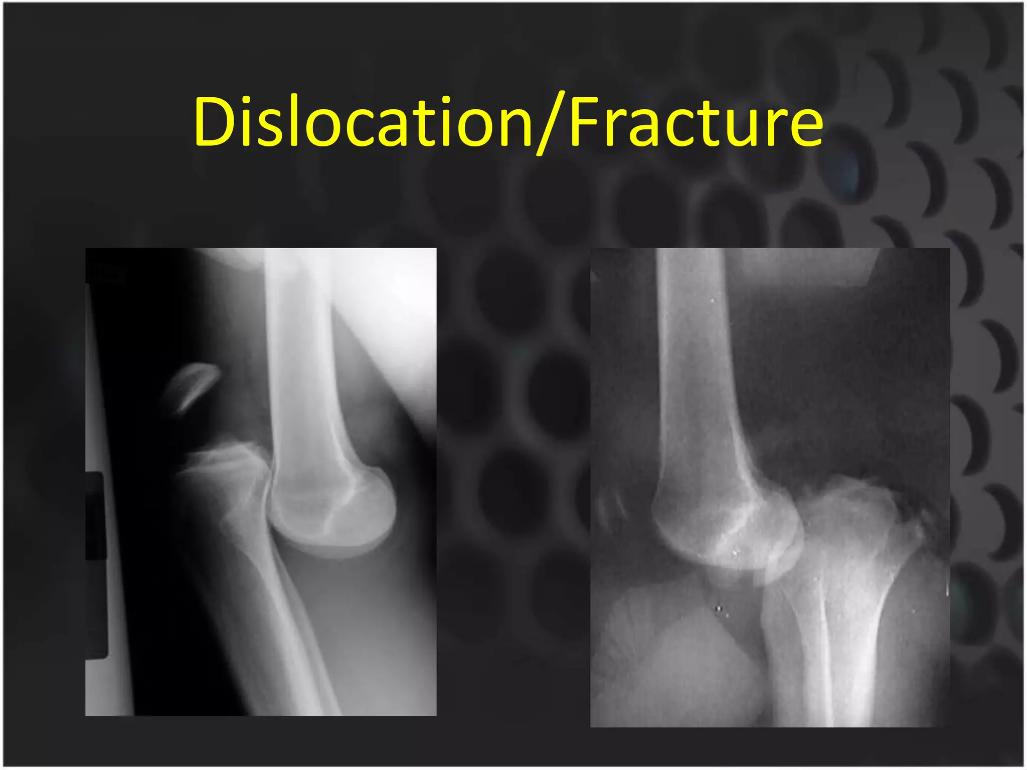 Dislocation/Fracture