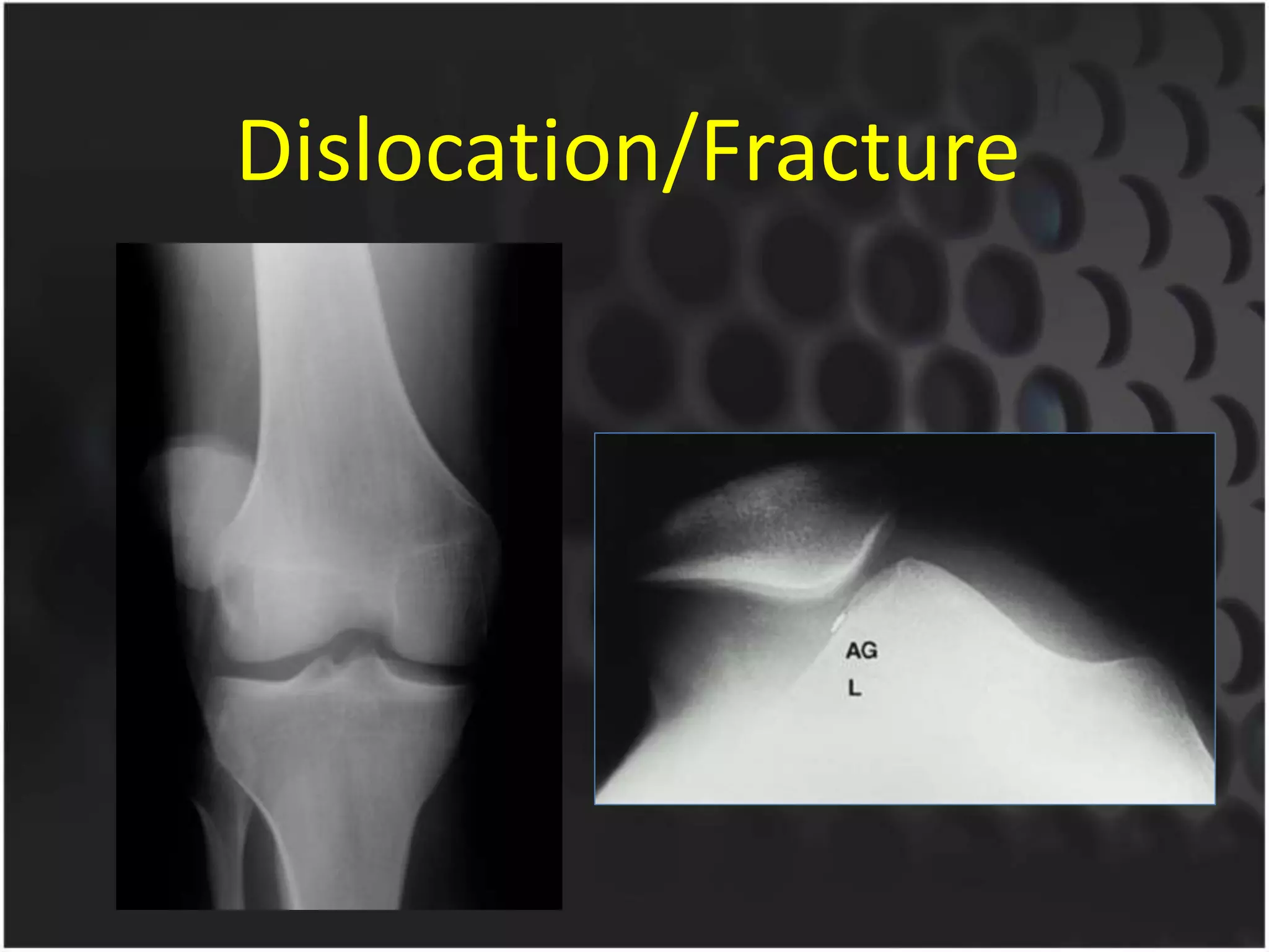 Dislocation/Fracture