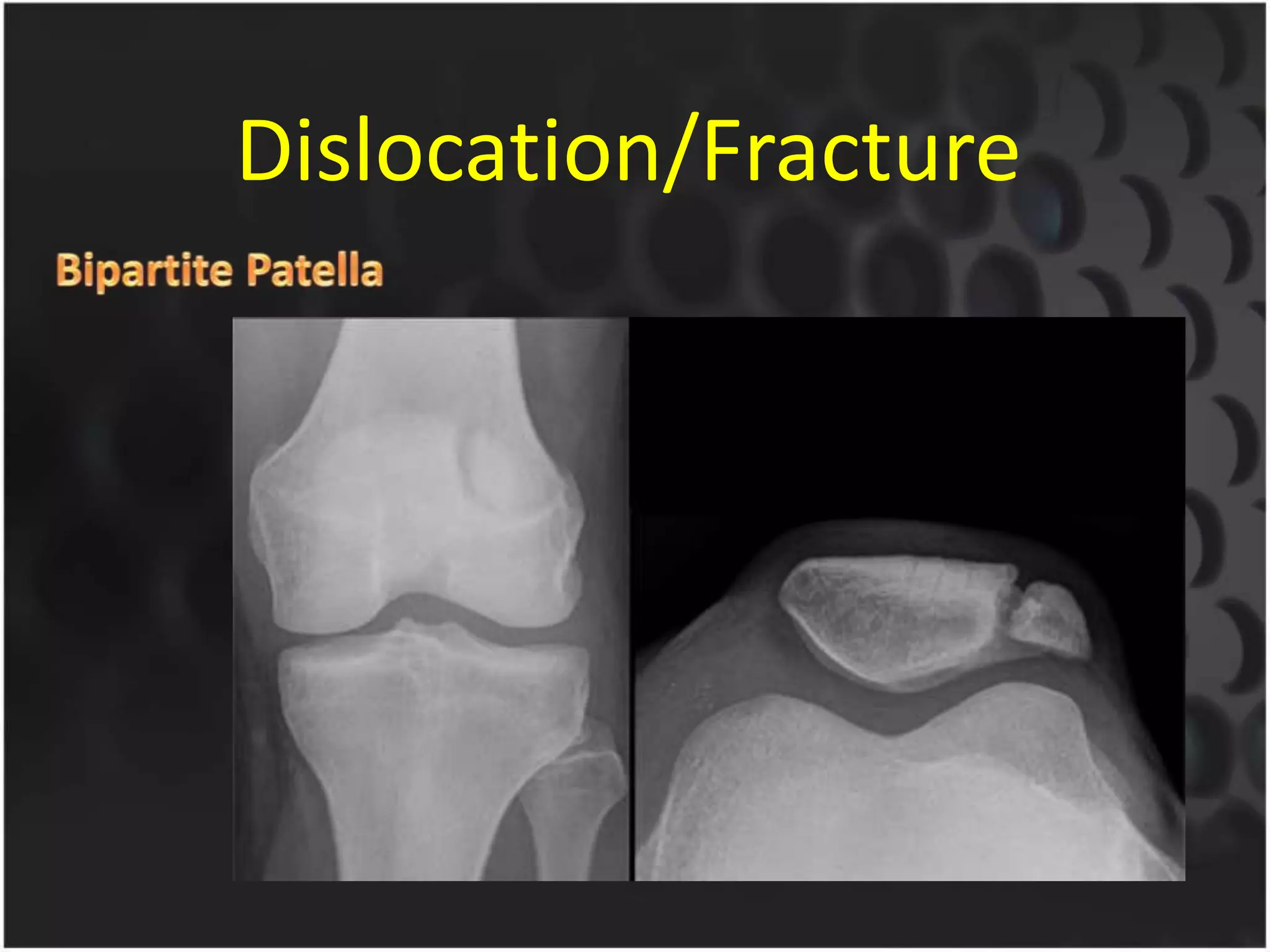 Dislocation/Fracture
