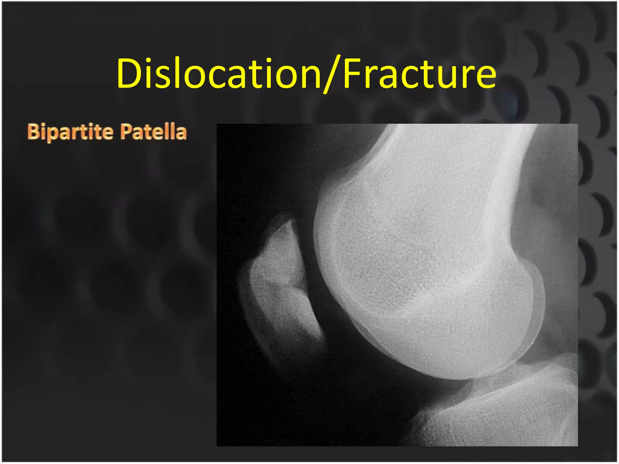 Dislocation/Fracture