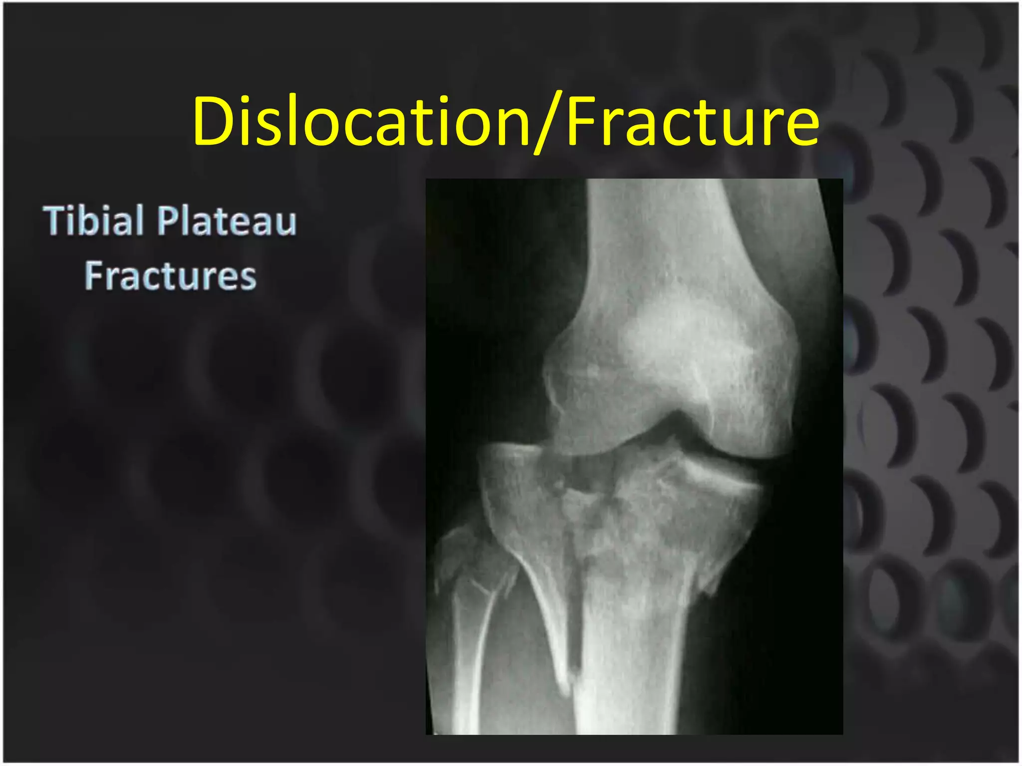 Dislocation/Fracture
