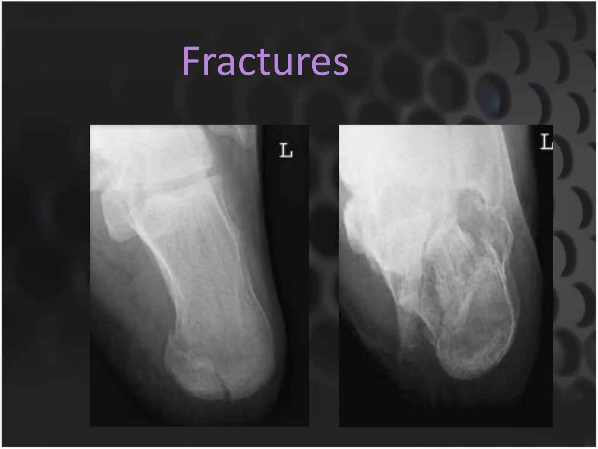 Fractures