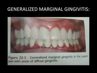 Clinical reatures of gingivitis | PPTX