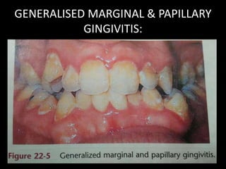 Clinical reatures of gingivitis | PPTX