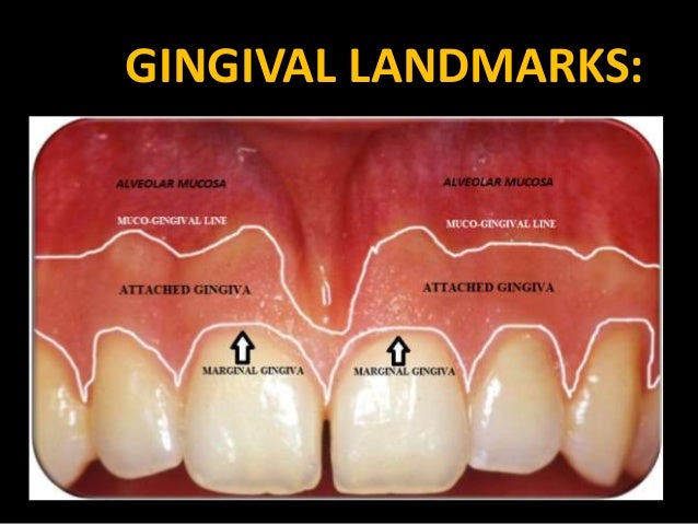 Clinical reatures of gingivitis