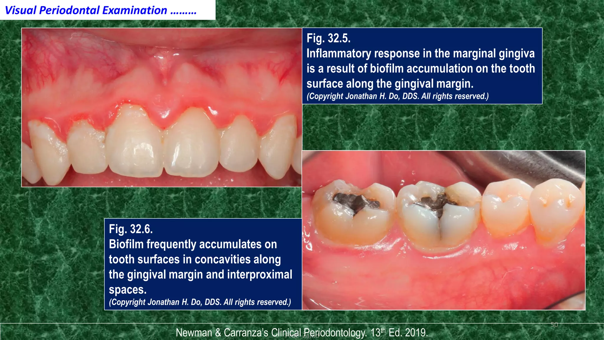 Clinical risk assessment & diagnosis of periodontal disease | PDF