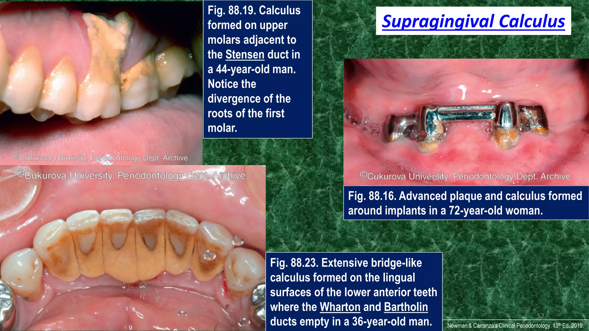 Clinical risk assessment & diagnosis of periodontal disease | PDF