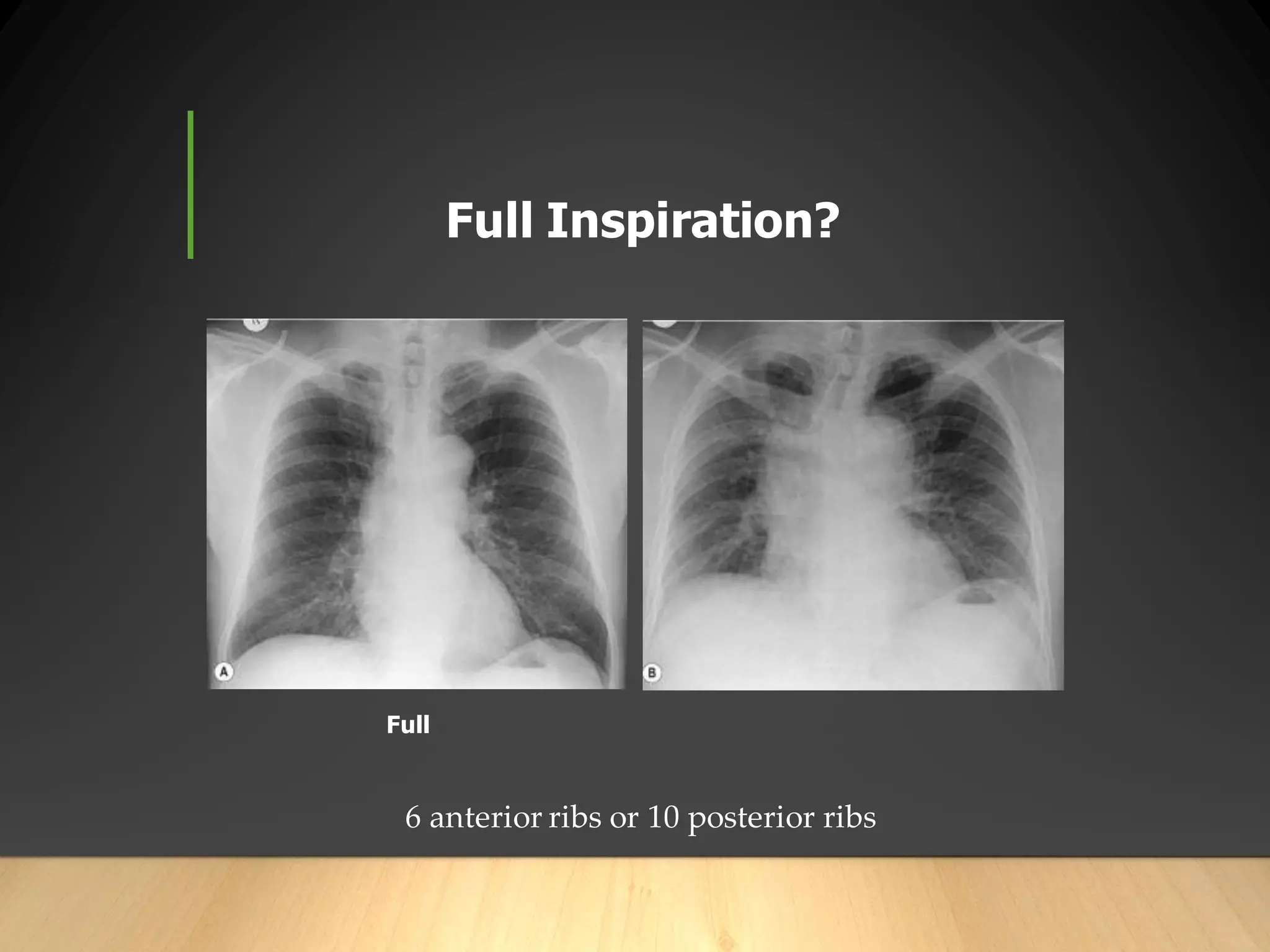 Inspiration Normal Ribs CXR and abdominal film interpretation for medical student | PDF