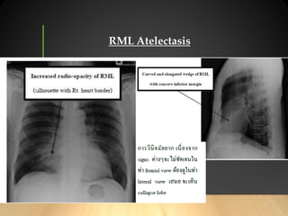 CXR and abdominal film interpretation for medical student | PDF