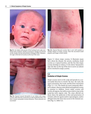 Clinical symptoms of eczema | PDF