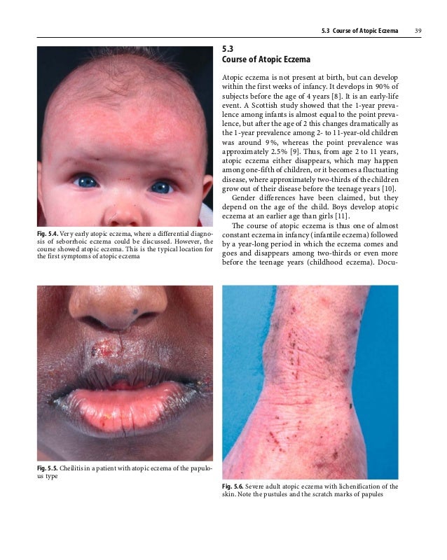 Clinical symptoms of eczema