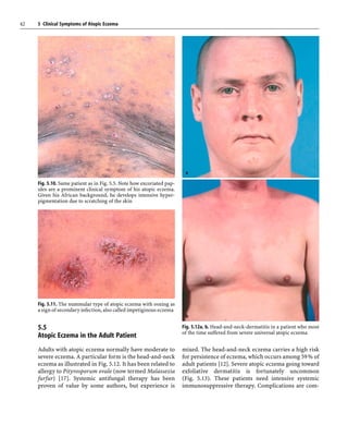 Clinical symptoms of eczema | PDF