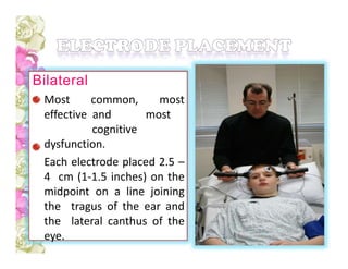 Bilateral
Most common, most
effective and most
cognitive
dysfunction.
Each electrode placed 2.5 –
4 cm (1-1.5 inches) on the
midpoint on a line joining
the tragus of the ear and
the lateral canthus of the
eye.
 