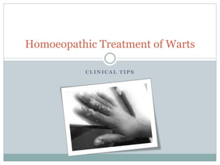 C L I N I C A L T I P S
Homoeopathic Treatment of Warts
 