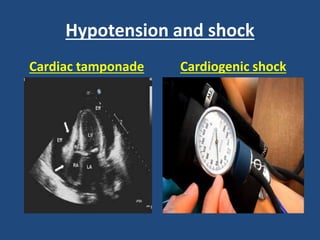 Hypotension and shock
Cardiac tamponade Cardiogenic shock
 
