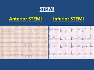 STEMI
Anterior STEMI Inferior STEMI
 