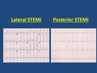 Lateral STEMI Posterior STEMI
 