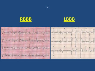 `
RBBB LBBB
 