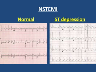 NSTEMI
Normal ST depression
 