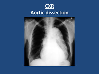 CXR
Aortic dissection
 