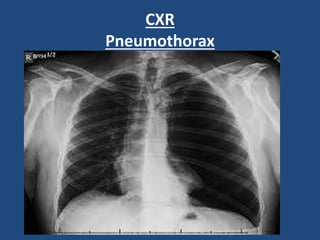 CXR
Pneumothorax
 