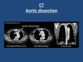 CT
Aortic dissection
 