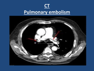 CT
Pulmonary embolism
 