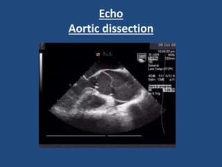 Echo
Aortic dissection
 