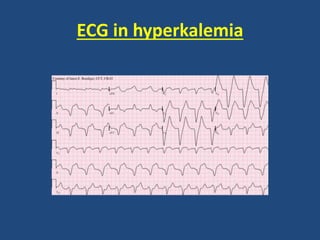 ECG in hyperkalemia
 