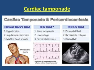 Cardiac tamponade
 