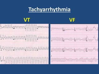 Tachyarrhythmia
VT VF
 