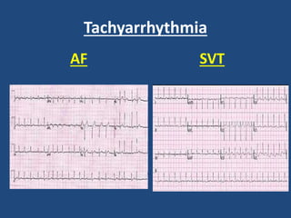 Tachyarrhythmia
AF SVT
 