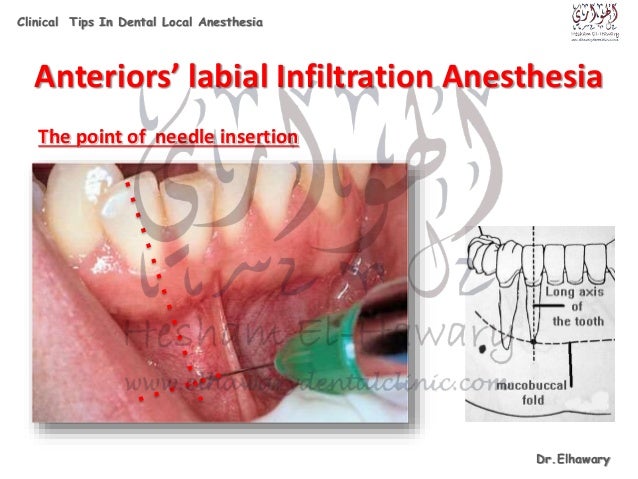 dental anesthesia