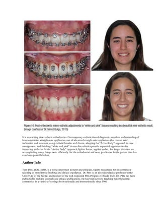 It is an exciting time to be in orthodontics.Contemporary esthetic-based diagnosis,a modern understanding of
how to optimize straight-wire appliances,use of advanced straight-wire appliances that control axial
inclination and rotations,using esthetic broader arch forms, adopting the “Active Early” approach to case
management, and finishing “white and pink” tissues foresthetics provide expanded opportunities for
improving esthetics.In the “Active Early” approach,lighter forces, applied earlier, for longer duration are
accomplishing many things more efficiently for the orthodontist and more gentleness forthe patient than has
ever been possible before.
Author Info
Tom Pitts, DDS, MSD, is a world-renowned lecturer and clinician, highly recognized for his continued
teaching of orthodontic finishing and clinical excellence. Dr. Pitts is an associate clinical professorat the
University of the Pacific and founder of the well-respected Pitts Progressive Study Club. Dr. Pitts has been
published in multiple journals and clinical publications. He has been actively teaching the orthodontic
community in a variety of settings both nationally and internationally since 1986.
 