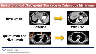 Ipilimumab and
Nivolumab
Week 12
Nivolumab
Baseline
Immunological Checkpoint Blockade in Cutaneous Melanoma
 