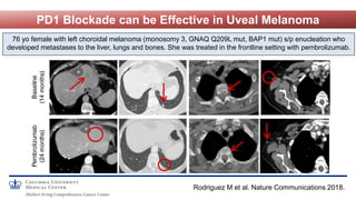 PD1 Blockade can be Effective in Uveal Melanoma
Rodriguez M et al. Nature Communications 2018.
76 yo female with left chor...