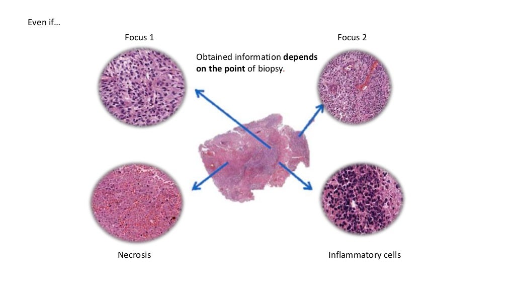 Detection Of Clustered Circulating Tumour Cells In Early Breast Cancer ...