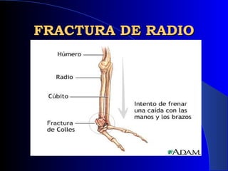 FRACTURA DE RADIOFRACTURA DE RADIO
 
