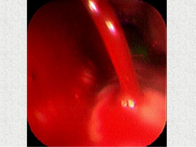 Exame gama glutamil transferase