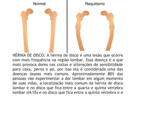 HÉRNIA DE DISCO: A hérnia de disco é uma lesão que ocorre
com mais frequência na região lombar. Essa doença é a que
mais provoca dores nas costas e alterações de sensibilidade
para coxa, perna e pé, por isso ela é considerada uma das
doenças ósseas mais comuns. Aproximadamente 80% das
pessoas vão experimentar a dor lombar em algum momento
de suas vidas. a localização mais comum da hérnia de disco
lombar é no disco que fica entre a quarta e quinta vértebra
lombar (l4/l5) e no disco que fica entre a quinta vértebra e o
 