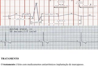 TRATAMENTO 
O tratamento é feito com medicamentos antiarrítmicos implantação de marcapasso. 
 