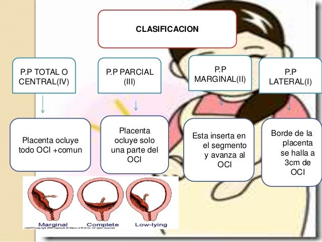 Complicaciones En El Embarazo Abortoppdppni Embarazo