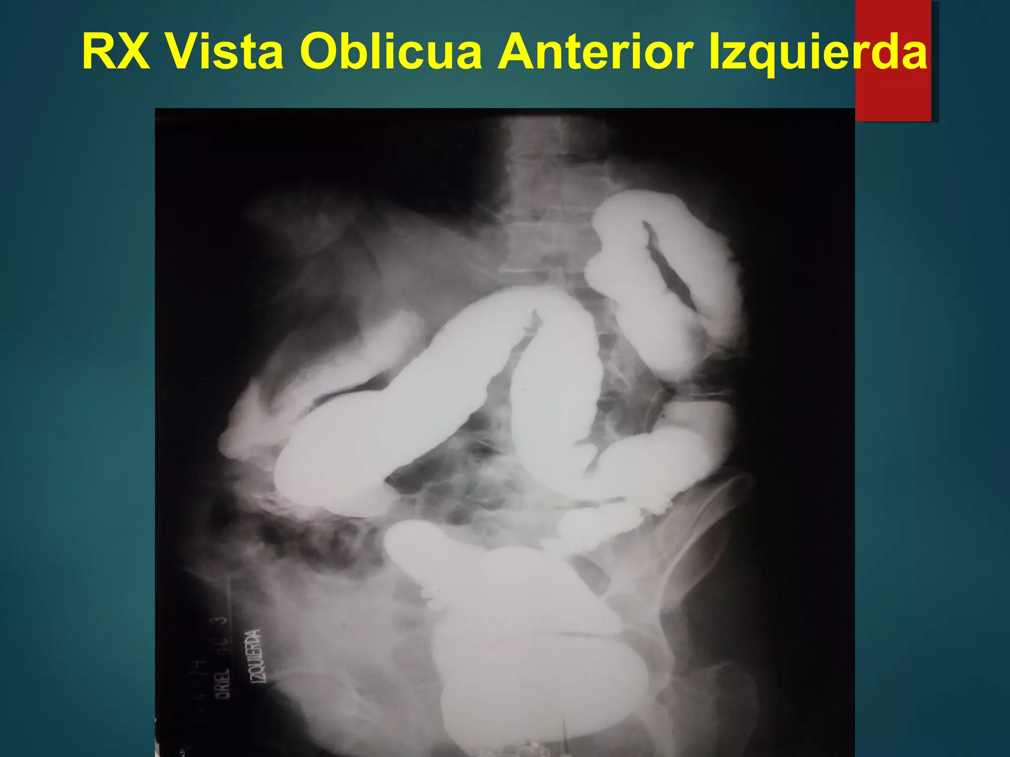 Colon En Rx Tumor en RX de colon x enema Diagnóstico Imagenológico Clínico ...