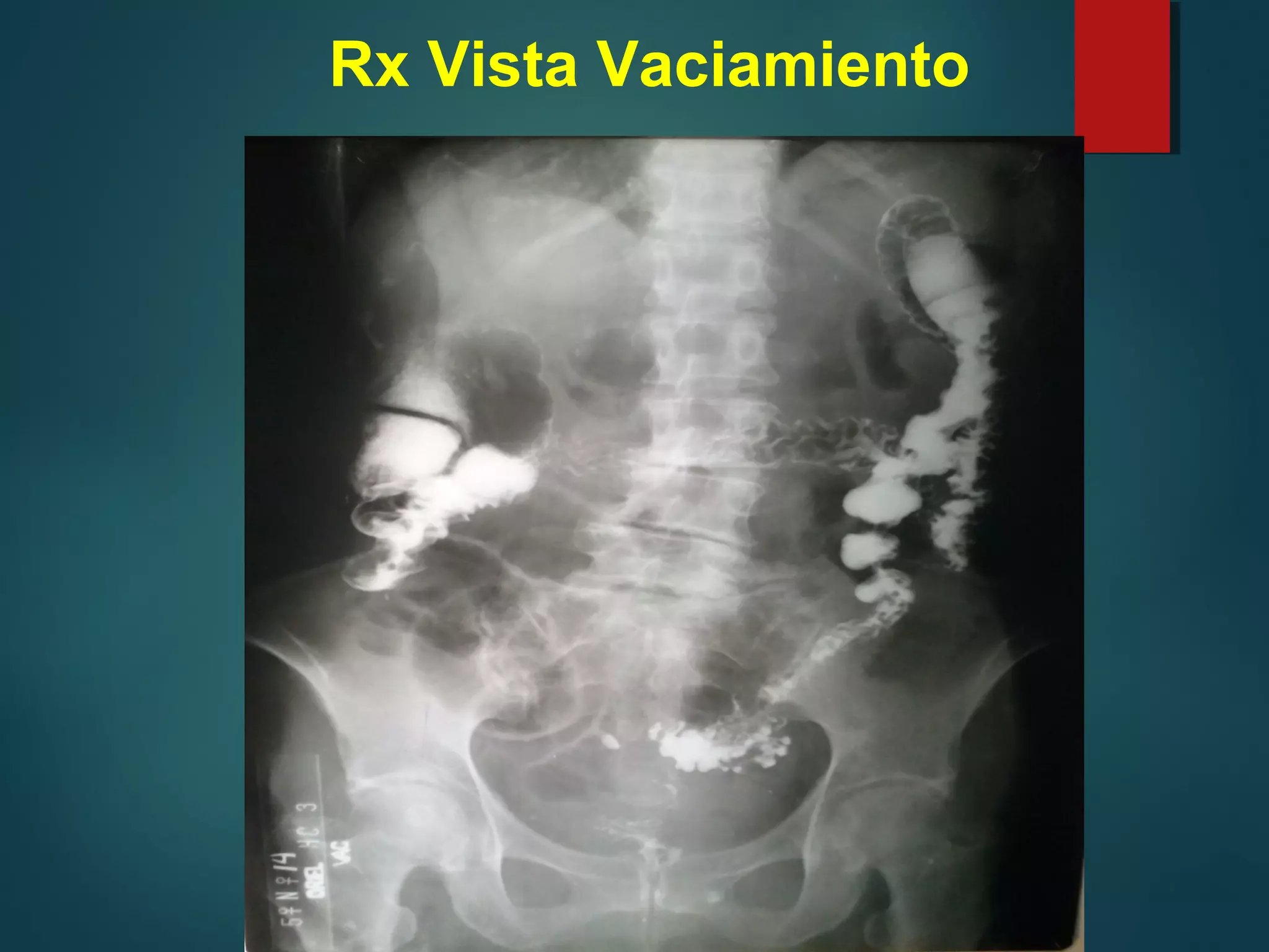 Colon Rx Label Tumor en RX de colon x enema Diagnóstico Imagenológico Clínico ...