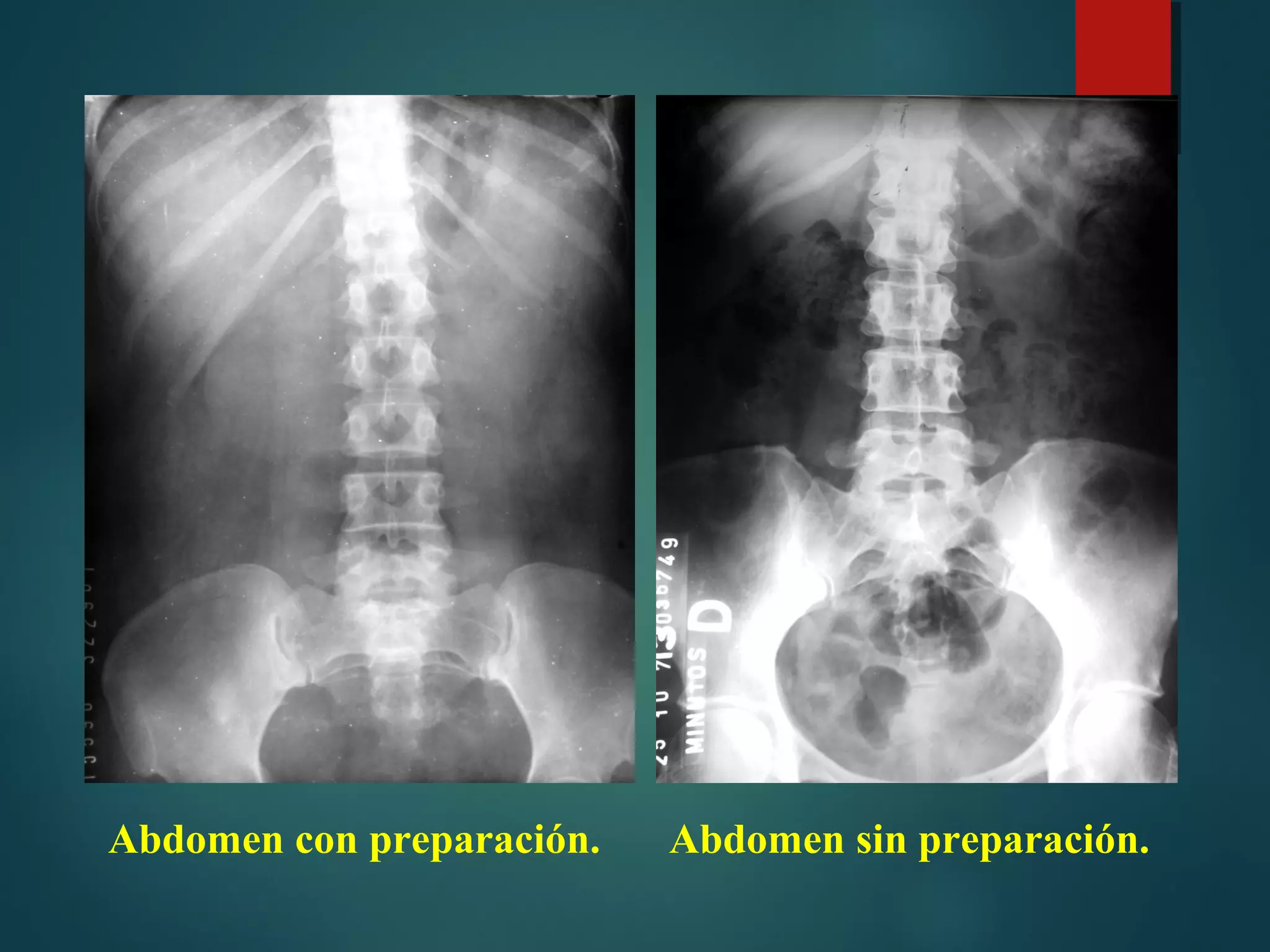 Colon En Rx Tumor en RX de colon x enema Diagnóstico Imagenológico Clínico ...