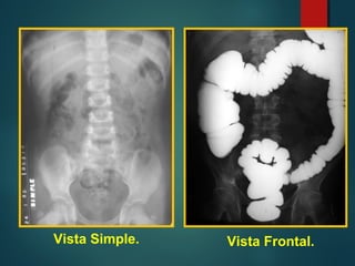 Colon En Rx Tumor en RX de colon x enema Diagnóstico Imagenológico Clínico ...
