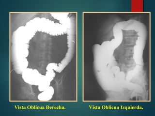 Colon En Rx Tumor en RX de colon x enema Diagnóstico Imagenológico Clínico ...