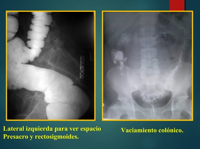 Colon En Rx Tumor en RX de colon x enema Diagnóstico Imagenológico Clínico ...